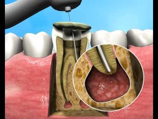 Новый подход в лечении апикальных повреждений \\ Treatment of Apical Periodontitis - a new approach