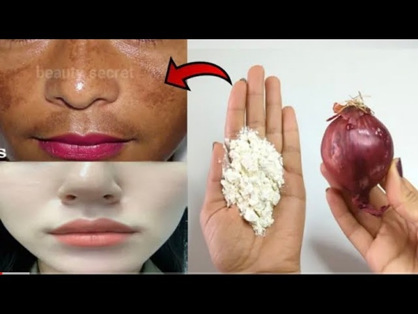 Mix onion with cornstarch to get skin white as snow and clear as